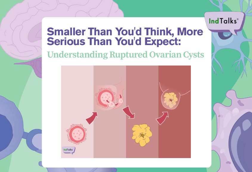 Smaller Than You'd Think, More Serious Than You'd Expect: Understanding Ruptured Ovarian Cysts